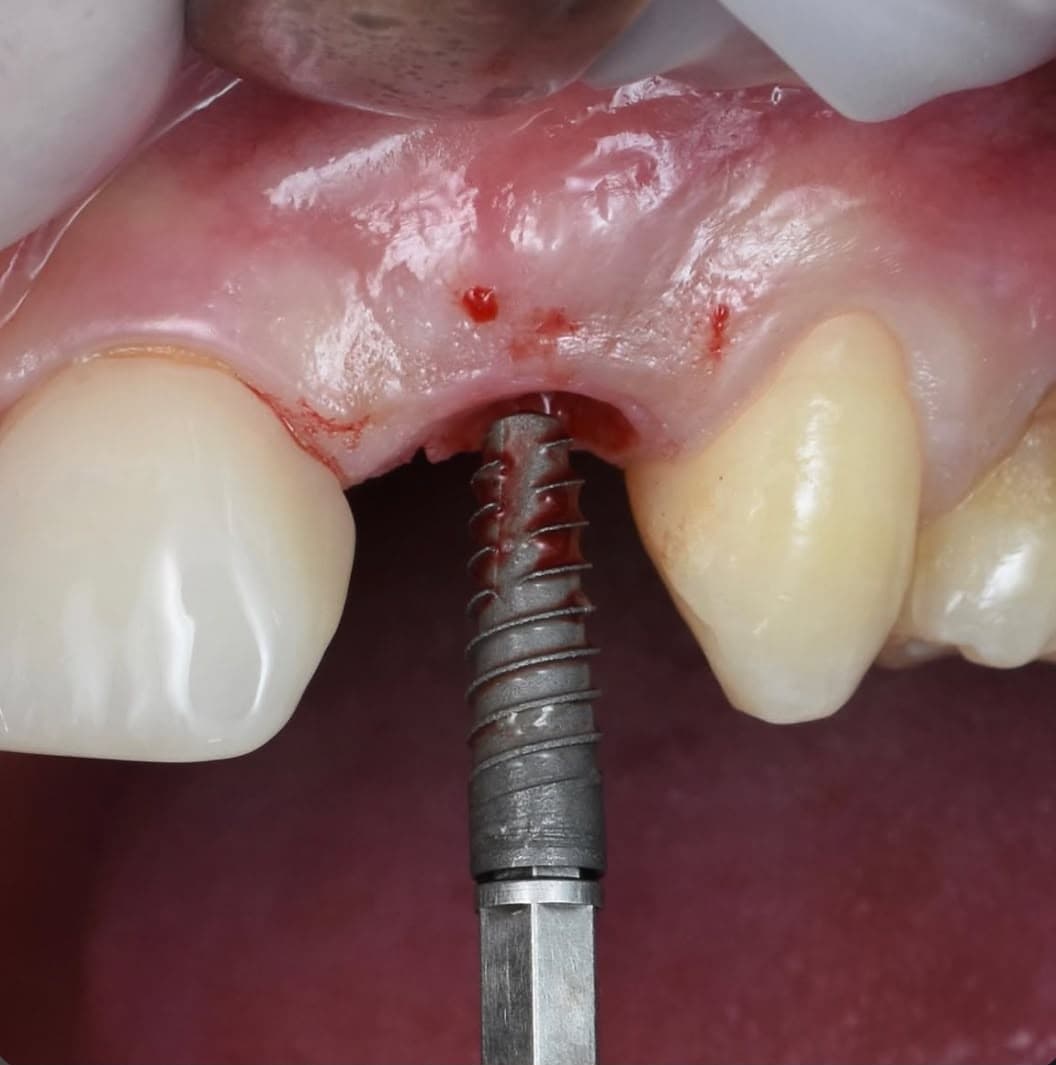 Pose d'un implant dentaire