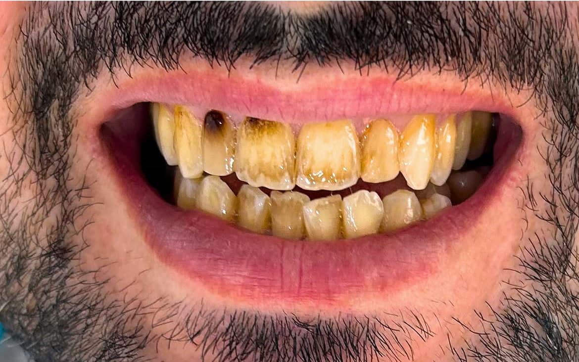 Vues photographiques cliniques d’un sourire, nuances visibles — Vue 2