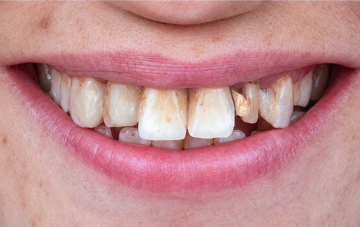 Vues photographiques cliniques d’un sourire, harmonie visible — Vue 2