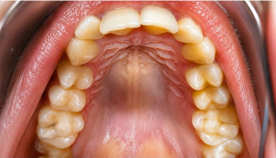 Composite photographique clinique d’une étape de suivi orthodontique — Étape 2